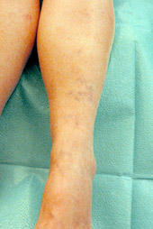 Before Sclerotherapy