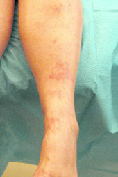 Immediately After Sclerotherapy