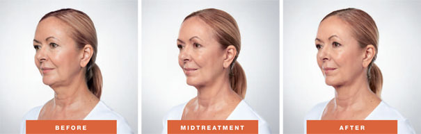 Woman before and after Kybella
